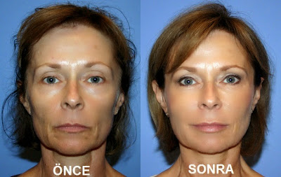 yüz estetiği, yüz germe ameliyatı, cilt germe operasyonu