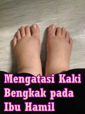Diyanika Journal Mengatasi Kaki Bengkak Pada Ibu Hamil