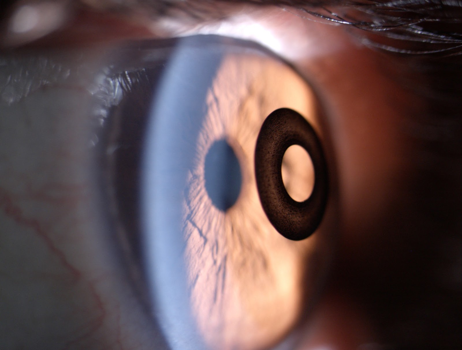 Глазок 24. Импланты зрения в медицине. Временный имплант глаза.