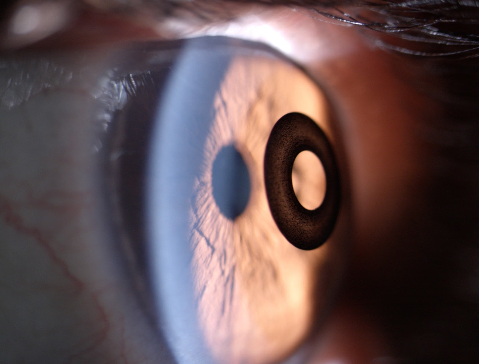 What You Need To Know About Presbyopic Refractive Surgery
