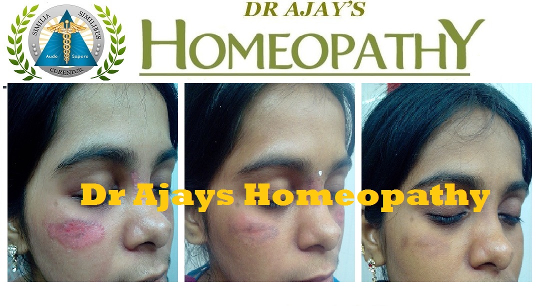 Dr Ajays Homeopathy Every skin disease find perfect cure in homeopathy