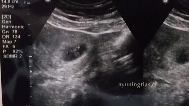 USG Pertama Kehamilan 6 Minggu  KISAH KASIH BUNDA