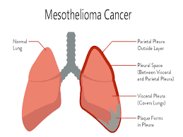 Mesothelioma Cancer Treatment