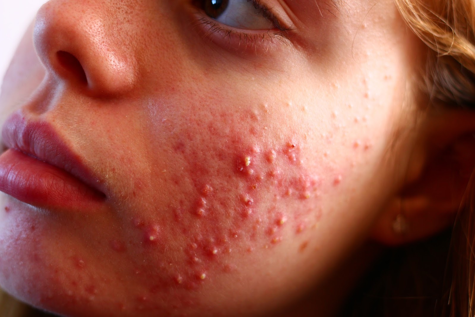 Why Acne Doesn't Define Me spots skincare acne teenager beauty blogger