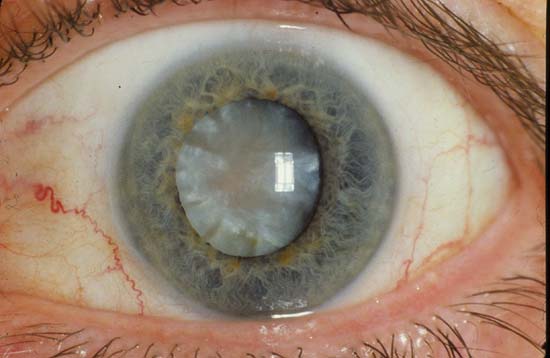pinpoint pupils diabetes pinpoint pupils diabetes