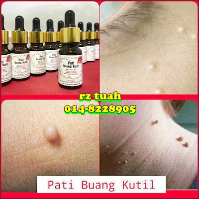 pati buang kutil tahi lalat bintil kolestrol