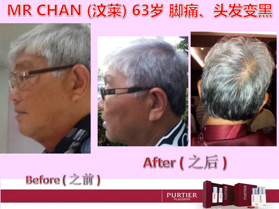 MR CHAN (BRUNEI) 63 YEARS OLD, LEG PAIN, HAIR GROW DARKER