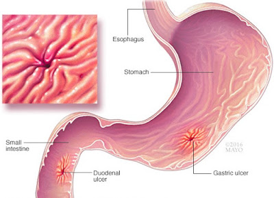 PEPTIC ULSER PEPTIC ULSER