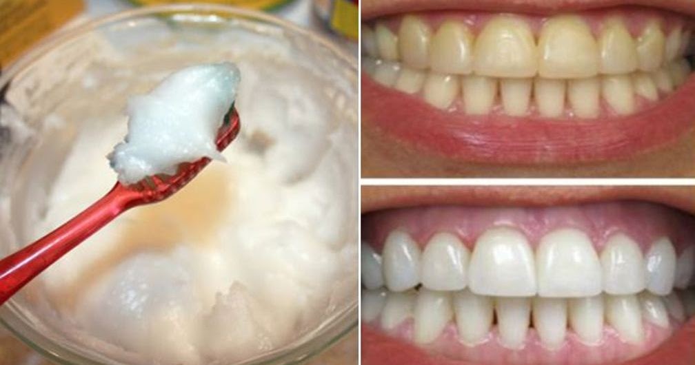 HOME REMEDY FOR SUPER FAST TEETH WHITENING WITH COCONUT OIL AND BAKING SODA Healthy centrals