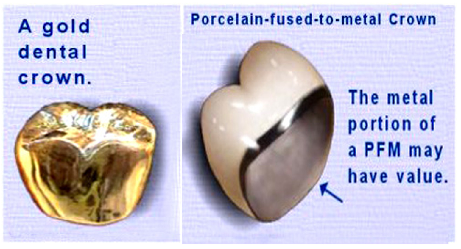 Presence of GOLD in Dental Crowns