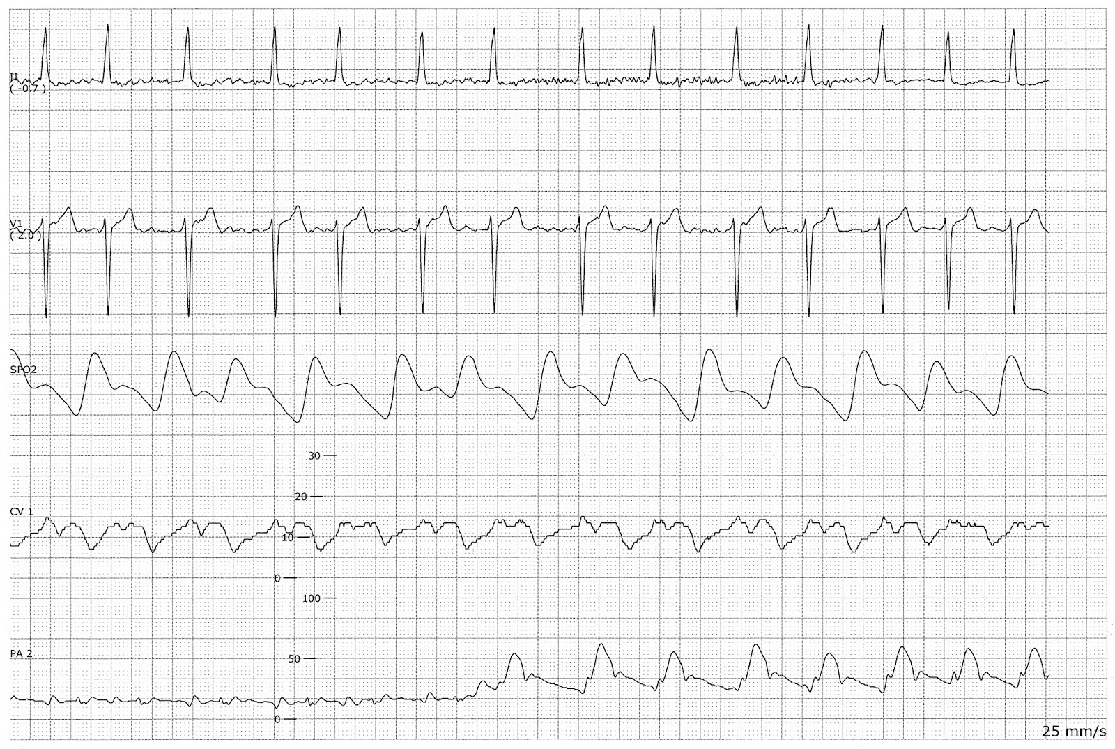 Pa Catheter Tracing