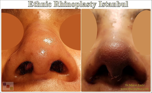 Ethnic Rhinoplasty Istanbul – Dr.Murat Enoz – Nose job in Istanbul – Nose surgery in Istanbul – Nose job in Turkey - Ethnic rhinoplasty Turkey - Ethnic rhinoplasty in Turkey - African American rhinoplasty - Ethnic expert nose job surgeon - Rhinoplasty surgeon in Istanbul - Black nose job - Rhinoplasty for ethnic nose - Rhinoplasty for African people - African American nose surgery – Rhinoplasty for African American Nose - Thick skin rhinoplasty - Rhinoplasty in istanbul Ethnic Rhinoplasty Istanbul – Dr.Murat Enoz – Nose job in Istanbul – Nose surgery in Istanbul – Nose job in Turkey - Ethnic rhinoplasty Turkey - Ethnic rhinoplasty in Turkey - African American rhinoplasty - Ethnic expert nose job surgeon - Rhinoplasty surgeon in Istanbul - Black nose job - Rhinoplasty for ethnic nose - Rhinoplasty for African people - African American nose surgery – Rhinoplasty for African American Nose - Thick skin rhinoplasty - Rhinoplasty in istanbul