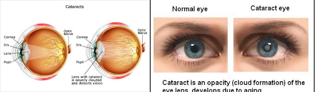 Cara Mengobati Mata Katarak Secara Alami, Efektif Dan Tanpa Efek Samping