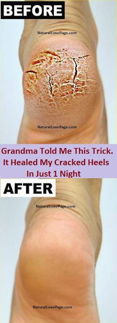 Grandma Told Me This Trick. It Healed My Cracked Heels In Just 1 Night