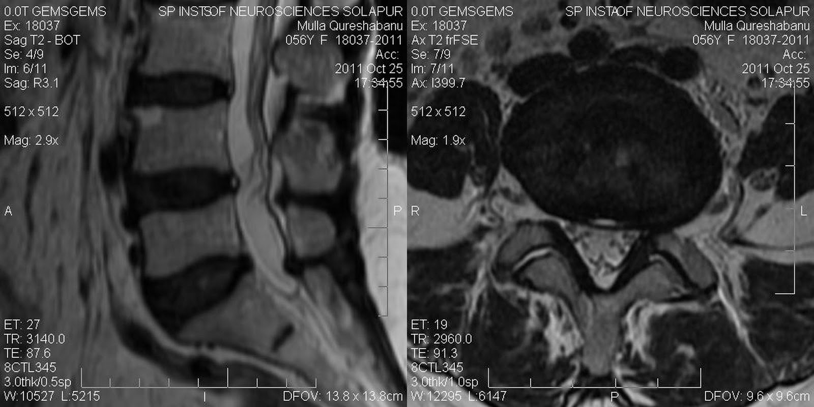 Dr Balaji Anvekar FRCR Disc Tear MRI Spine dr-balaji-anvekar-frcr-disc-tear-mri-spine