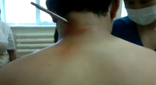 foto de um arpão cravado no pescoço de um pescador Russo