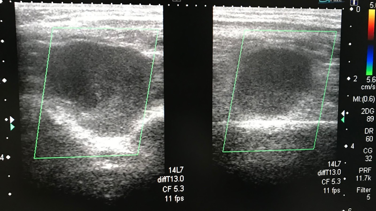 VIETNAMESE MEDIC ULTRASOUND CASE 535 LOWER LEG TUMOR, Dr PHAN THANH