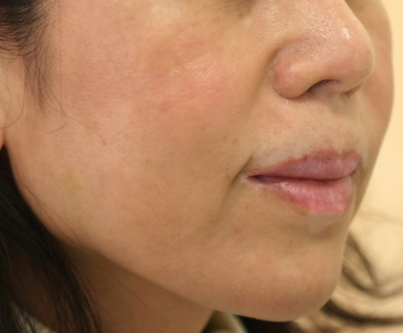 プチ整形の世界 鶴舞公園クリニック スプリングアプトスについて その2 付記 目の上の窪みへのヒアルロン酸注入について