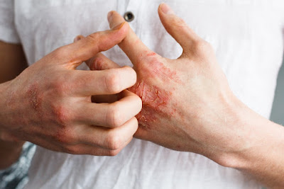 Ahlinya Obat Gatal Ahlinya Obat Gatal