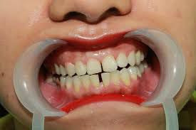Bảo tồn răng cửa bị chấn thương cần chú ý