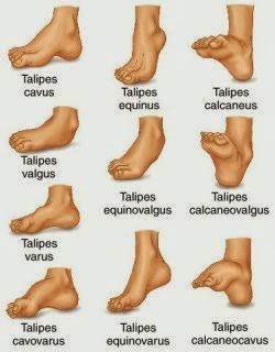 Foot Talk Club Foot Talipes The Holy Foot