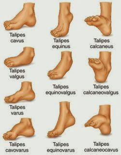 Talipes | Club Foot