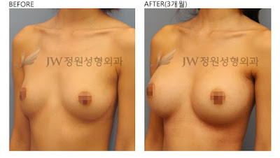 Nâng ngực không phẫu thuật là gì