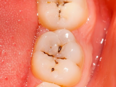 Chữa sâu răng bằng cách nào ? Chữa sâu răng bằng cách nào ?