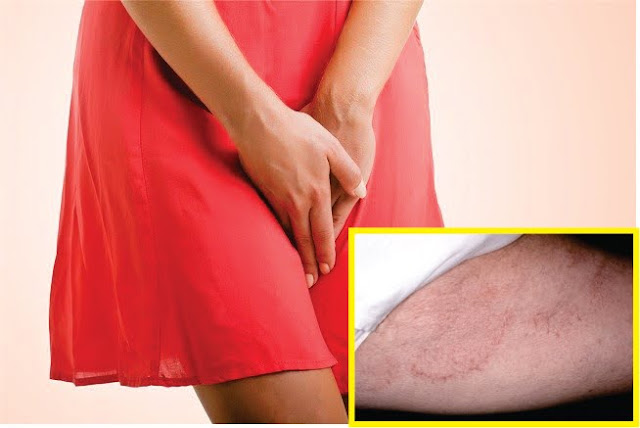 Gatal Di Area Selakangan Bukan Berarti Terkena Sifilis Ya Ladies, Ternyata Ini Sebabnya Dan Begini Cara Mengatasinya Gatal Di Area Selakangan Bukan Berarti Terkena Sifilis Ya Ladies, Ternyata Ini Sebabnya Dan Begini Cara Mengatasinya