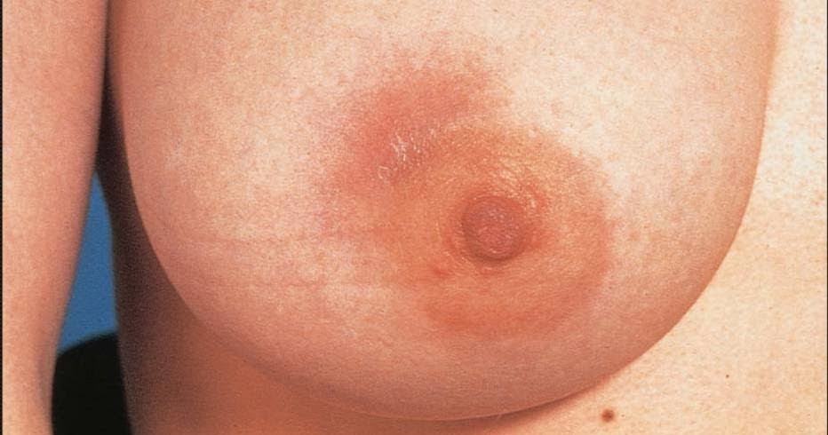 Best of Sore and redness by breast by Sore and breast redness