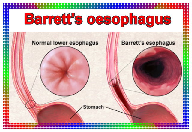 Barrett's oesophagus
