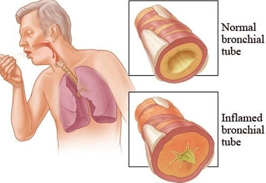 The most effective home remedies to treat bronchitis The most effective home remedies to treat bronchitis
