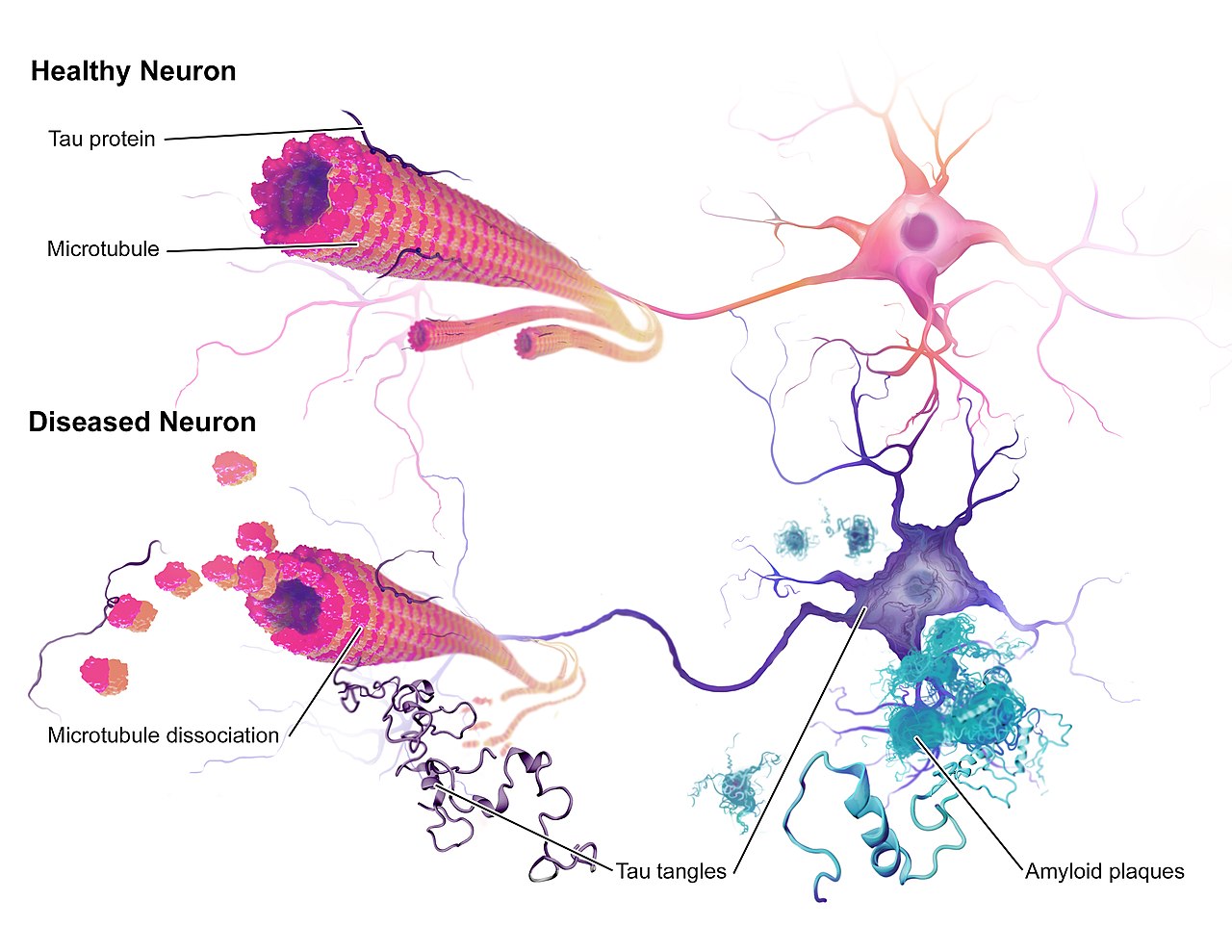 The Biology of Health Removing Tau Protein in Alzheimer's Disease A