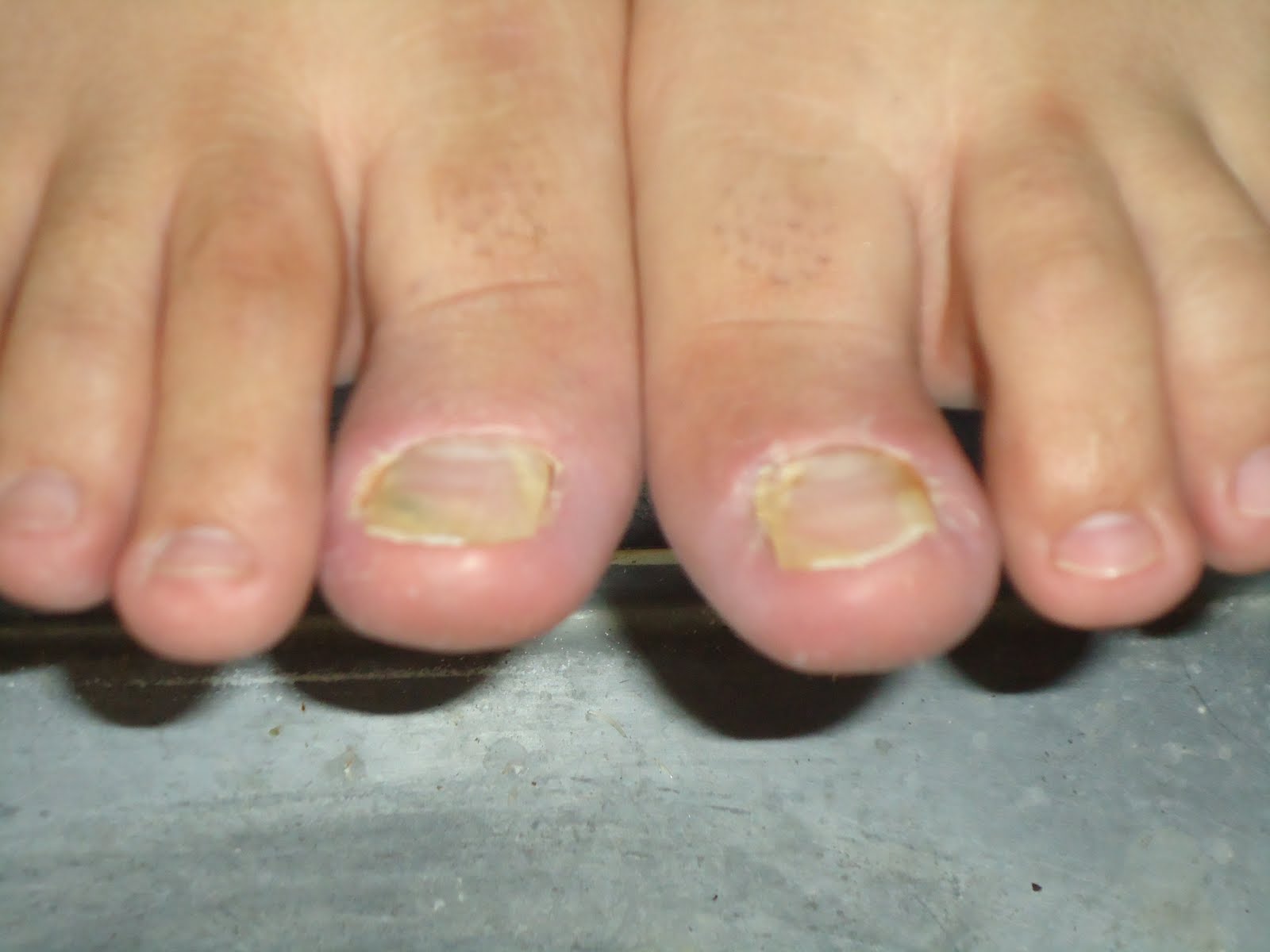 Dedo Gordo Principio De Hongos En Las Uñas