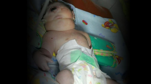 Bayi Bermata Satu Lahir di Mandailing Natal, Diduga Ini Penyebabnya! Bayi Bermata Satu Lahir di Mandailing Natal, Diduga Ini Penyebabnya!