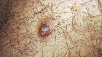 Image Bagaimana cara sembuhkan kutil di rambut kemaluan