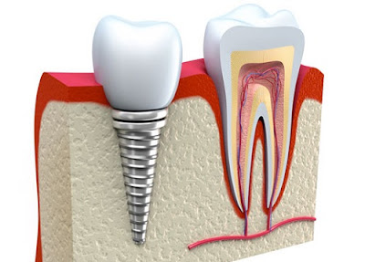 có nên cắm ghép răng implant không -15 có nên cắm ghép răng implant không -15