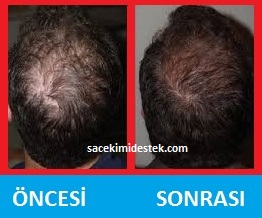 saç mezoterapisi öncesi ve sonrası 25