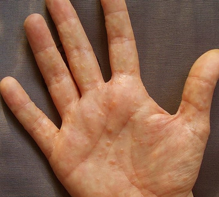 SKIN DISEASE TYPES Vesicular Hand Dermatitis (Skin Disease type)