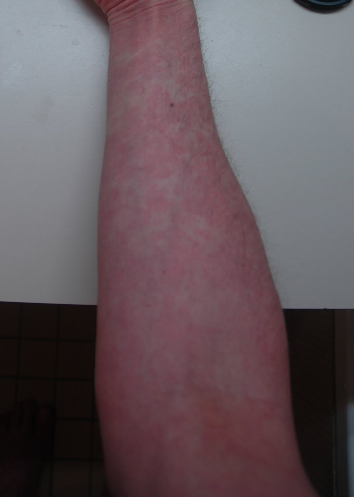 rash on forearms only
