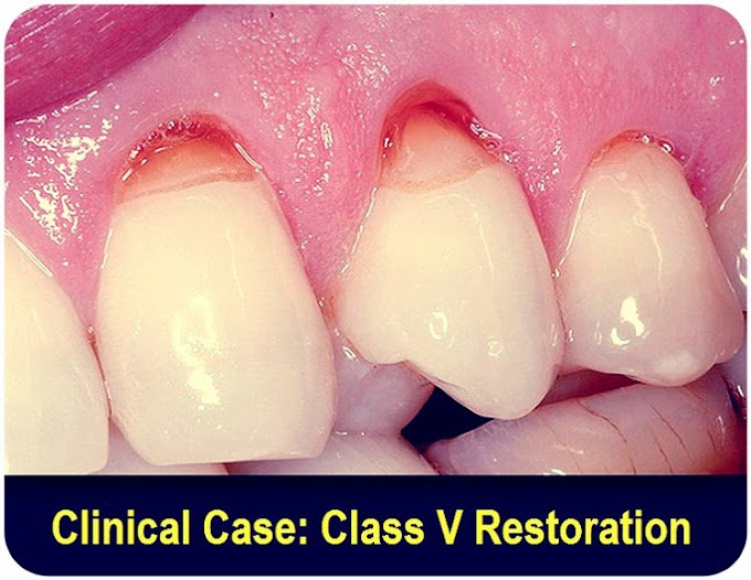 CLASS V RESTORATION: Clinical Case - Dr. Ahmed Khairy
