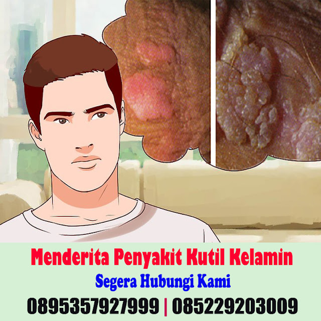 Obat Kutil Kelamin Obat Kutil Kelamin