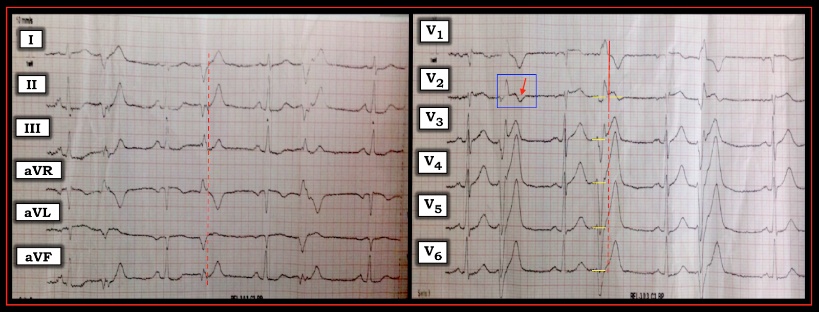 Dr. Smith's ECG Blog Hyperacute Twaves and Concordant ST Elevation