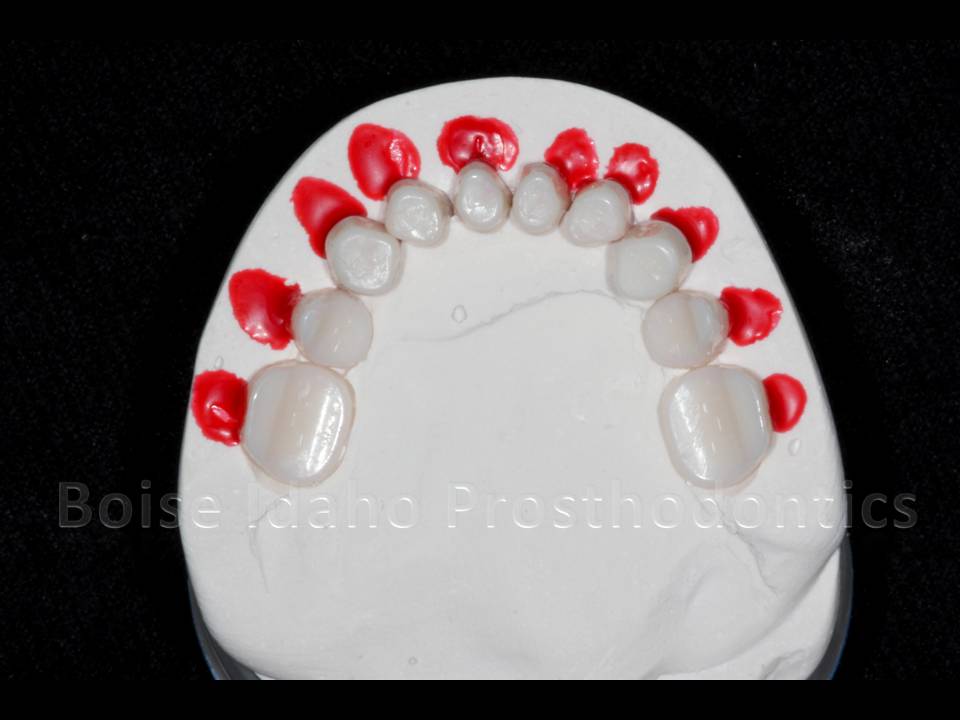 Boise Idaho Prosthodontics: May 30, 2012