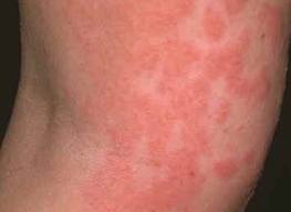 Related Pictures & Quizzes - Rash 101: The Most Common ...