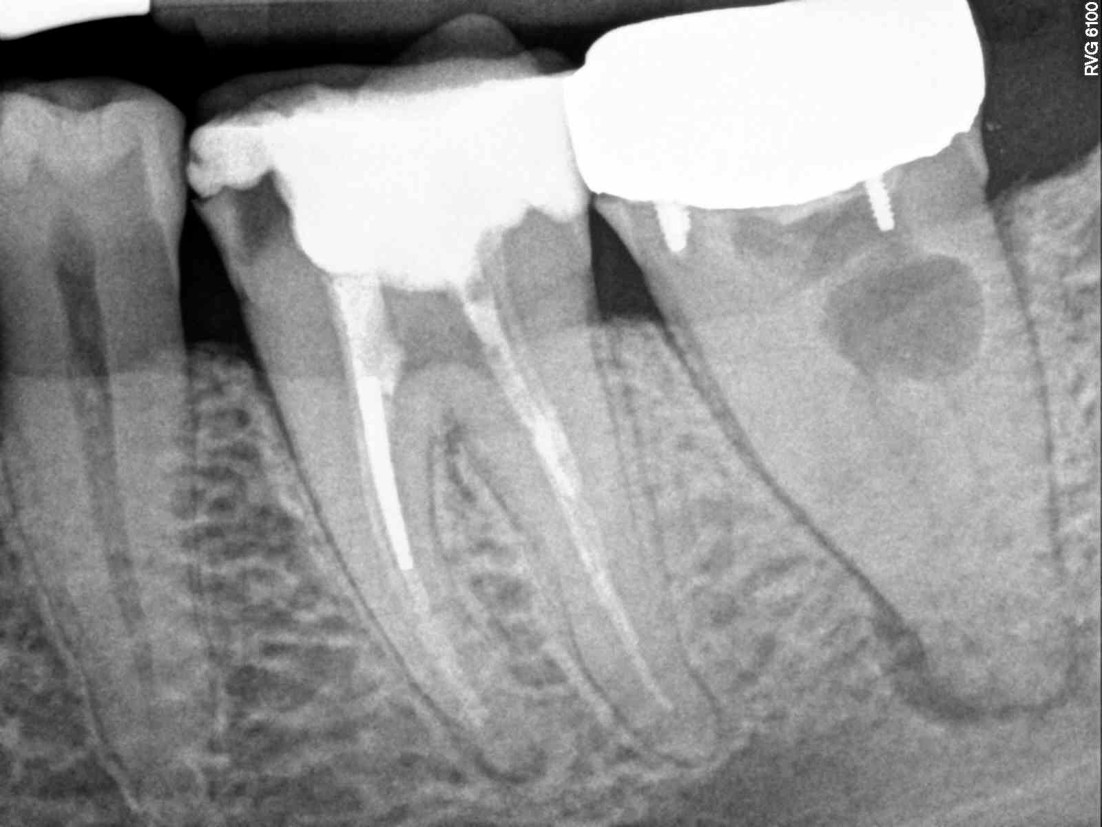 REASONS FOR VISITING DENTIST Dental Retreatment (part 1) Root Canal
