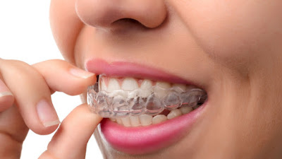  Niềng răng không mắc cài có hiệu quả gì?