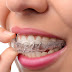  Niềng răng không mắc cài có hiệu quả gì?