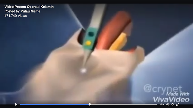 Video: Ternyata Beginilah Proses Operasi Kel4min Pria ke Wanita Video: Ternyata Beginilah Proses Operasi Kel4min Pria ke Wanita