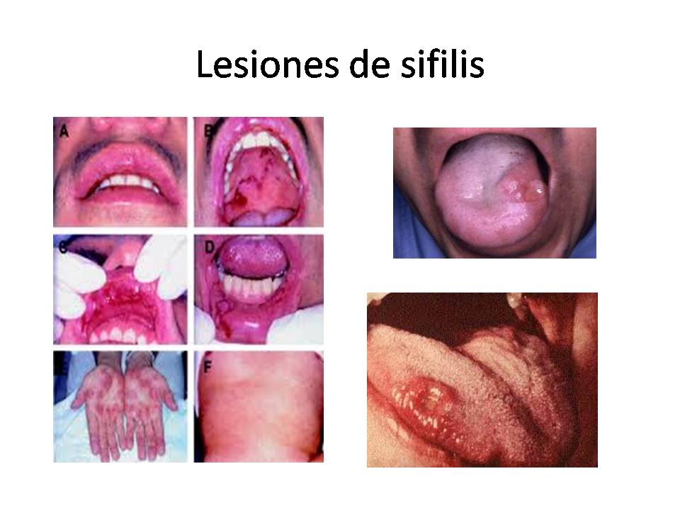 Herpes Simplex Virus Type 1 Picture Image on MedicineNet.com